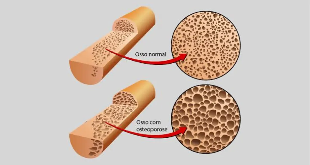 7 respostas rápidas sobre Osteoporose