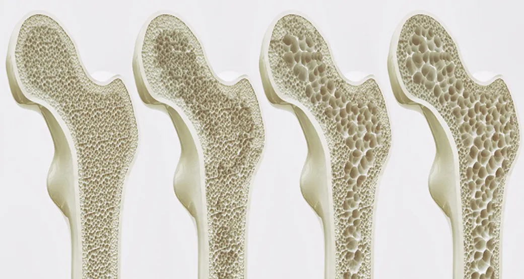 Até 2040 osteoporose deve aumentar mais de 200%