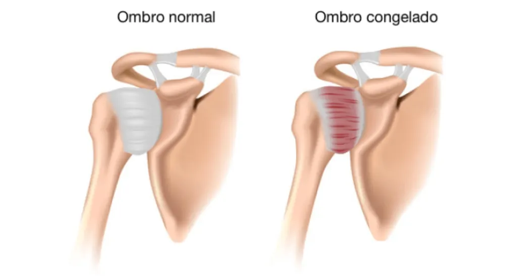 Capsulite adesiva: o que é ombro congelado?