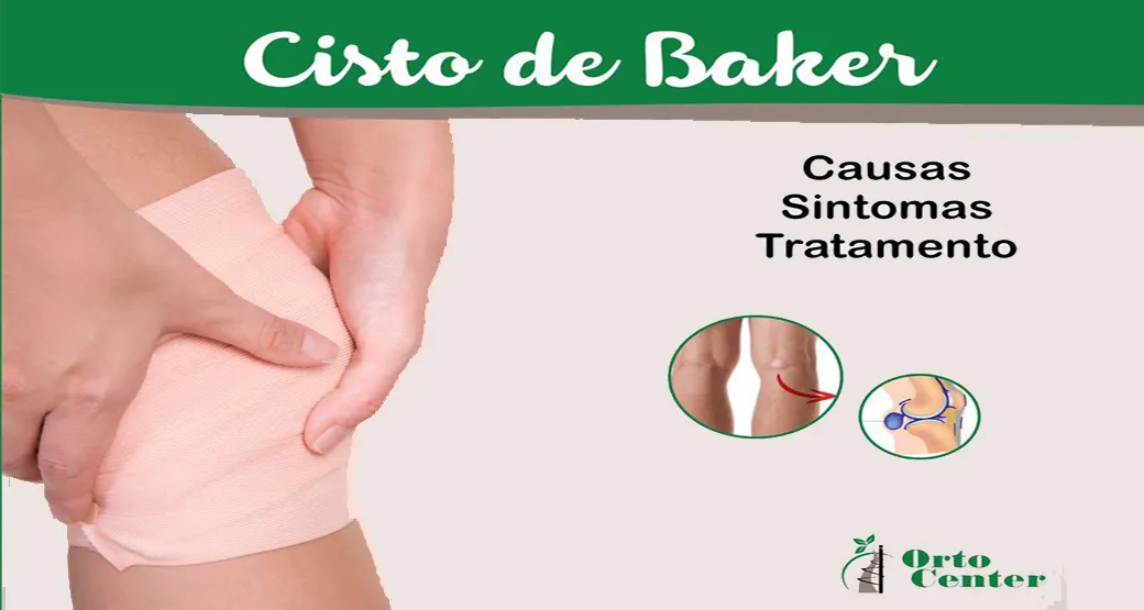 Conheça o cisto de Baker