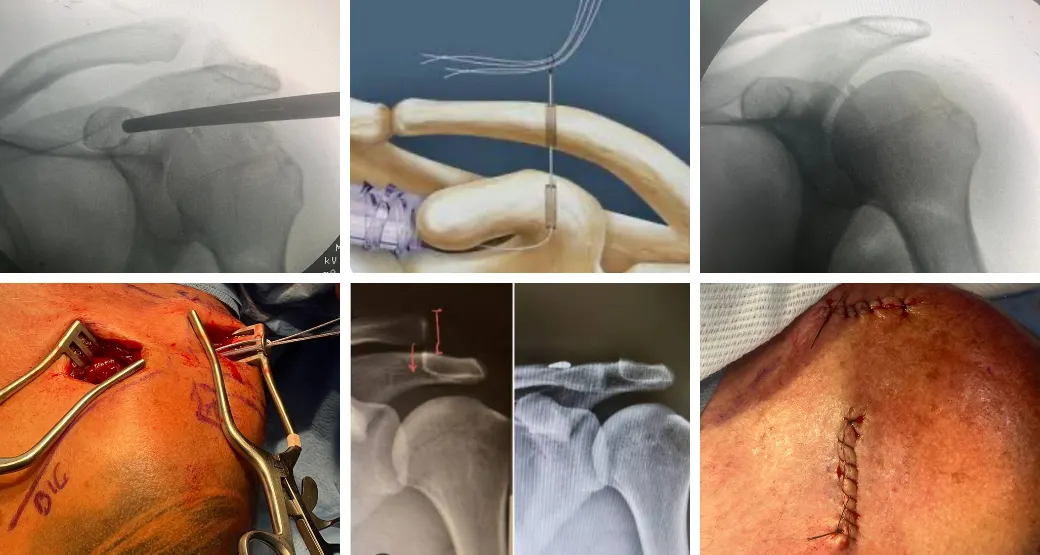 ENTREVISTA: Um caso clínico de luxação acromioclavicular. Cirurgia é a melhor indicação?