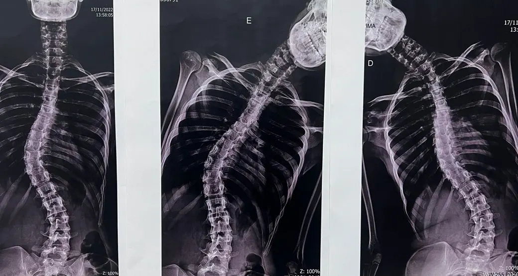 Escoliose em crianças e adolescentes: a importância do diagnóstico precoce