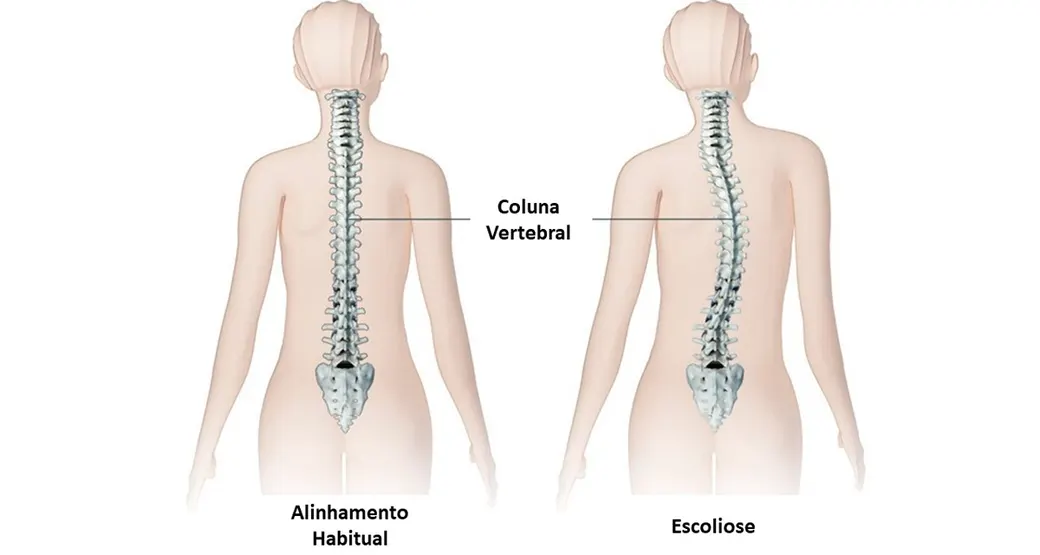 Escoliose