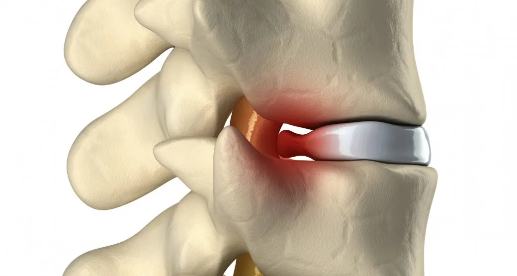 Hérnia de disco cervical e cirurgia de discectomia