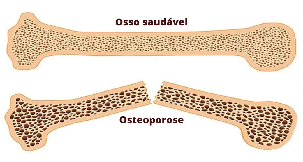 O que é osteoporose?