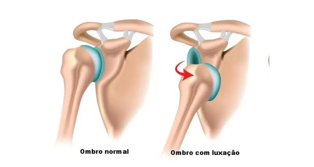 O que é uma luxação?