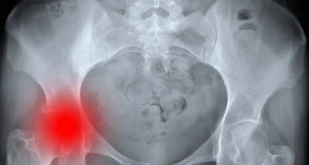 O que você precisa saber sobre cirurgia do quadril