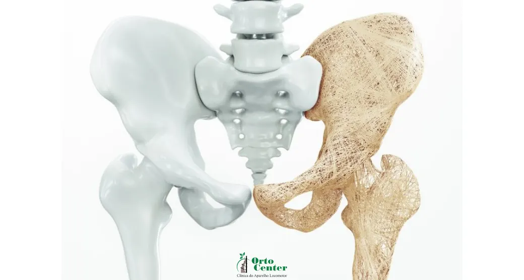 Os benefícios do tratamento infusional para osteoporose