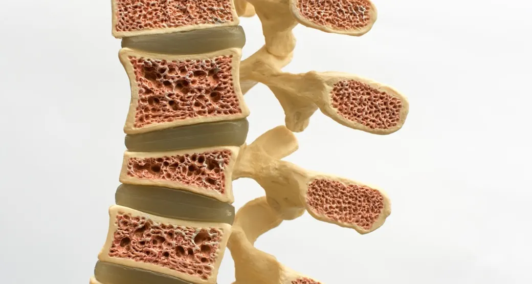 Osteoporose: Dicas essenciais para o tratamento