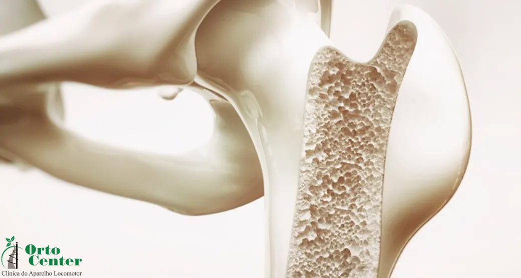Osteoporose: verdades e mitos