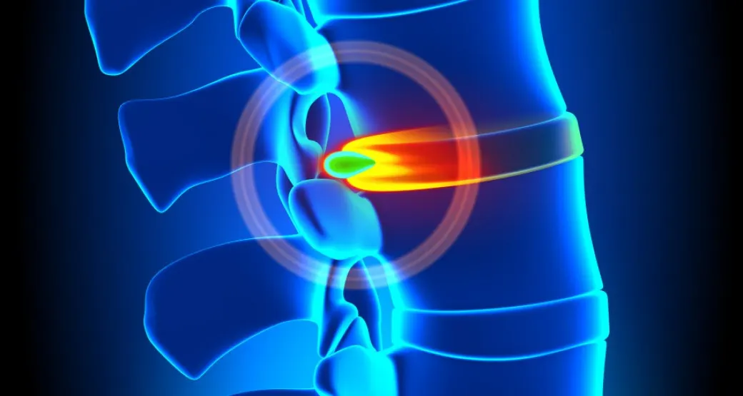 Saiba mais sobre a nucleoplastia da coluna