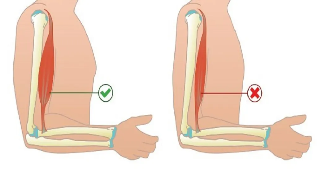 SARCOPENIA: Saiba o que é a doença e como identificar o tratamento