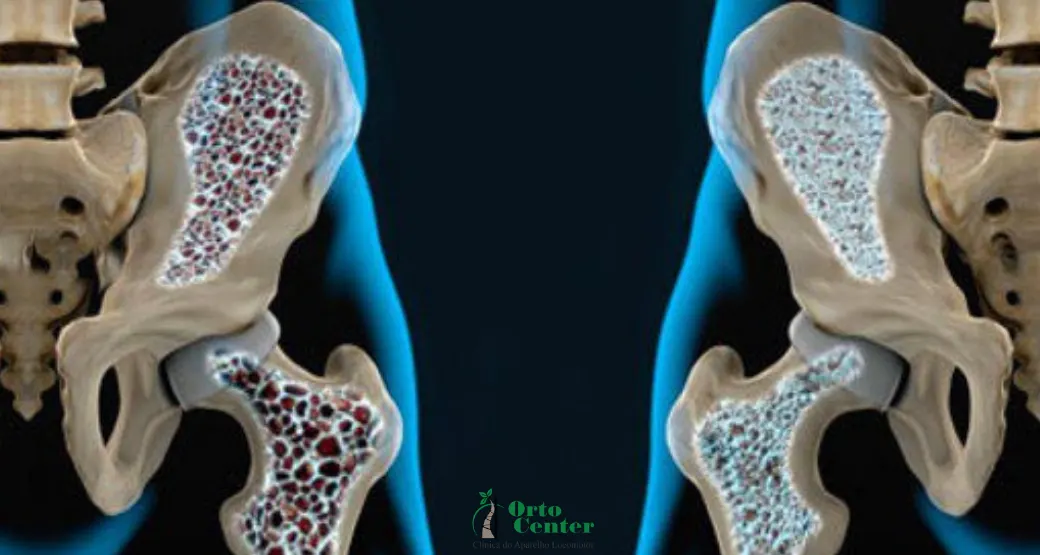 Tratamento infusional transforma a vida de quem tem Osteoporose