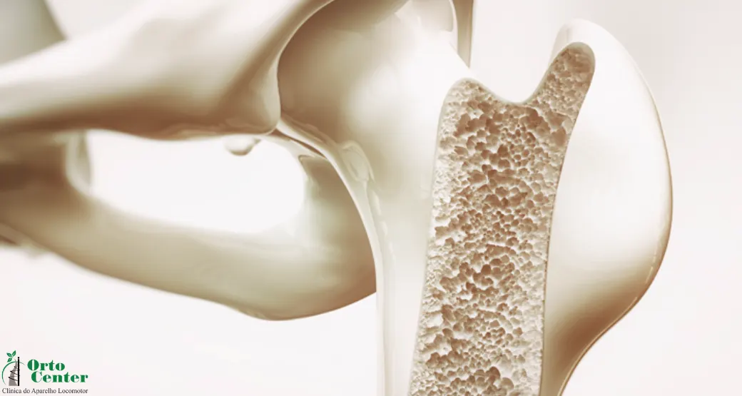 Tratamento melhora a vida de quem tem Osteoporose