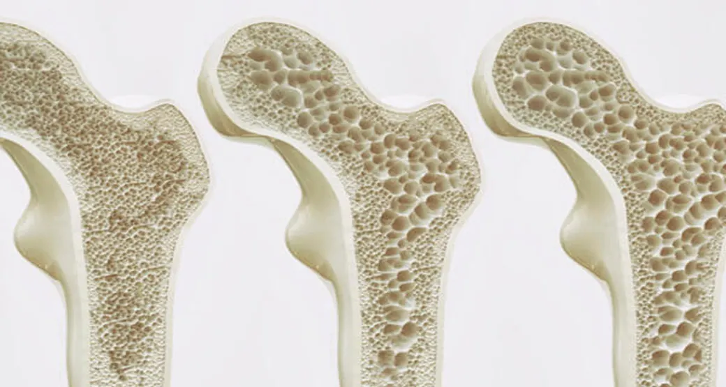 Você sabe o que é Osteopenia?