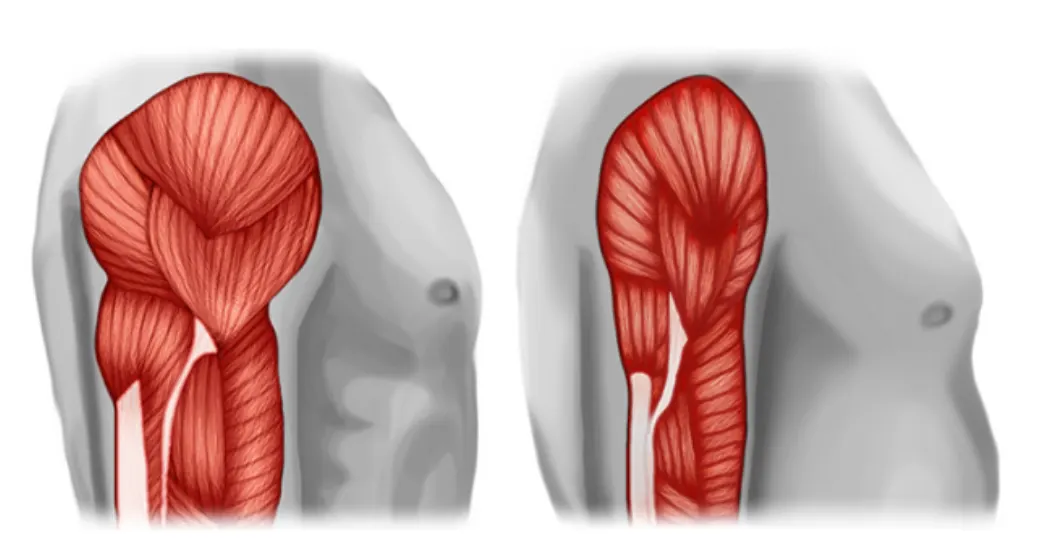 Você sabe o que é SARCOPENIA?