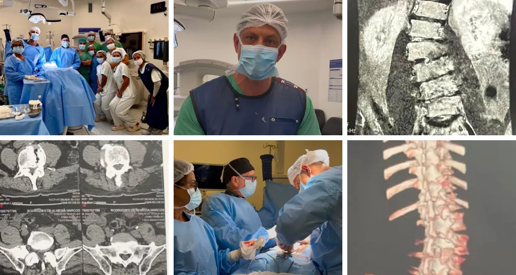 10 horas depois de cirurgia coluna estável. Paciente idoso com escoliose grave
