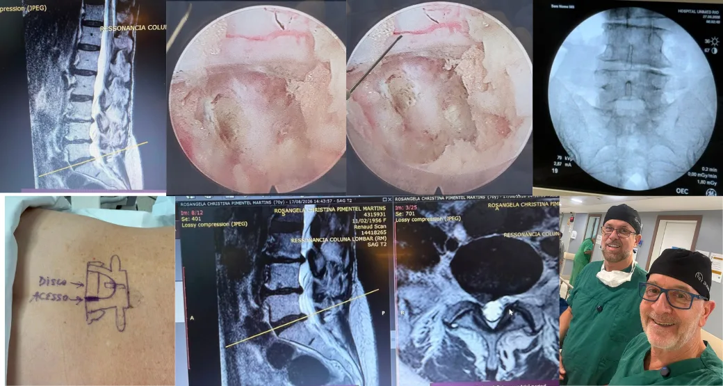 70 anos, compressão tripla: hérnia, artrose e ligamento espessado.