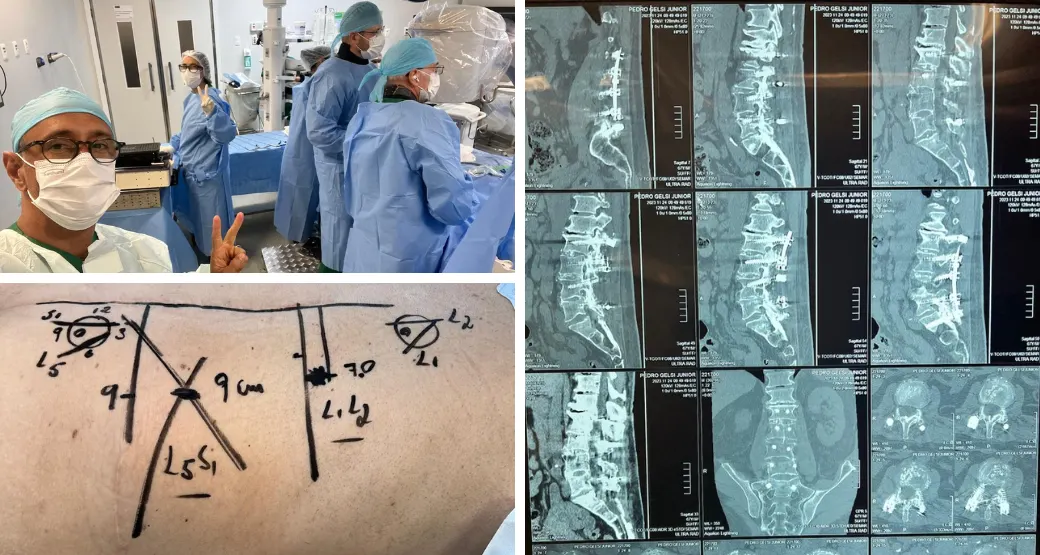 A Artrodese pode ser feita em pacientes com múltiplos pontos de compressão na coluna?