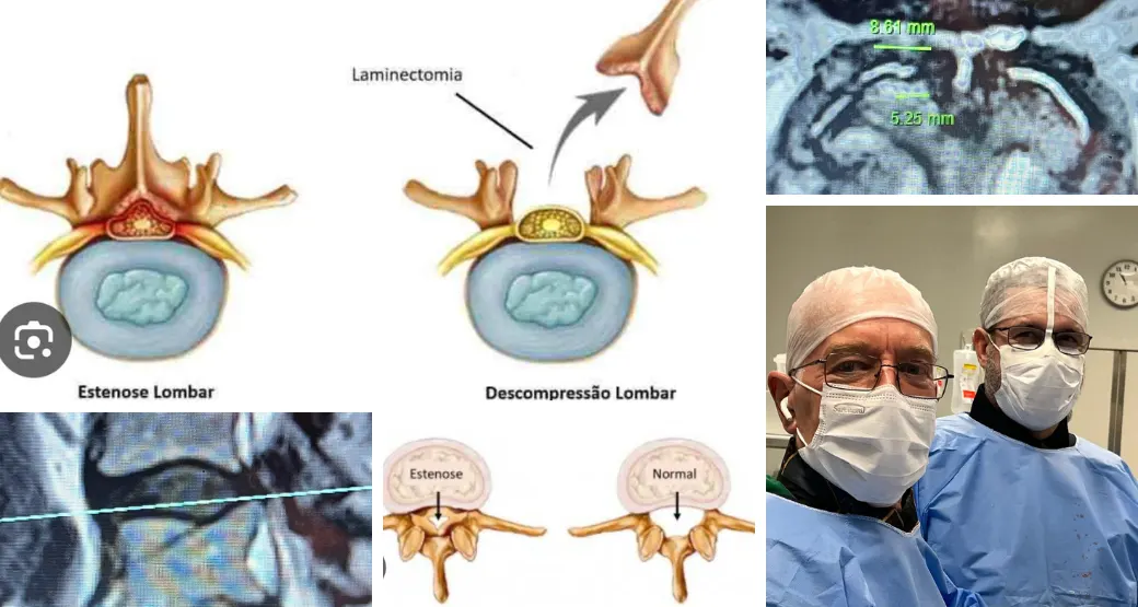 A cirurgia endoscópica resolve a estenose lombar da coluna vertebral do paciente?