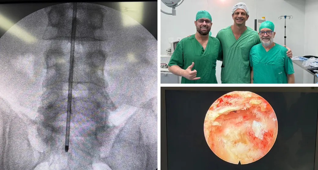 A cirurgia endoscópica resolve o problema da hérnia de disco?