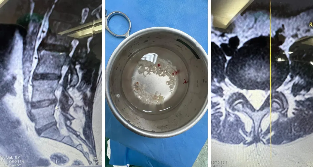A discectomia endoscópica lombar é indicada para pacientes com hérnia de disco lombar?