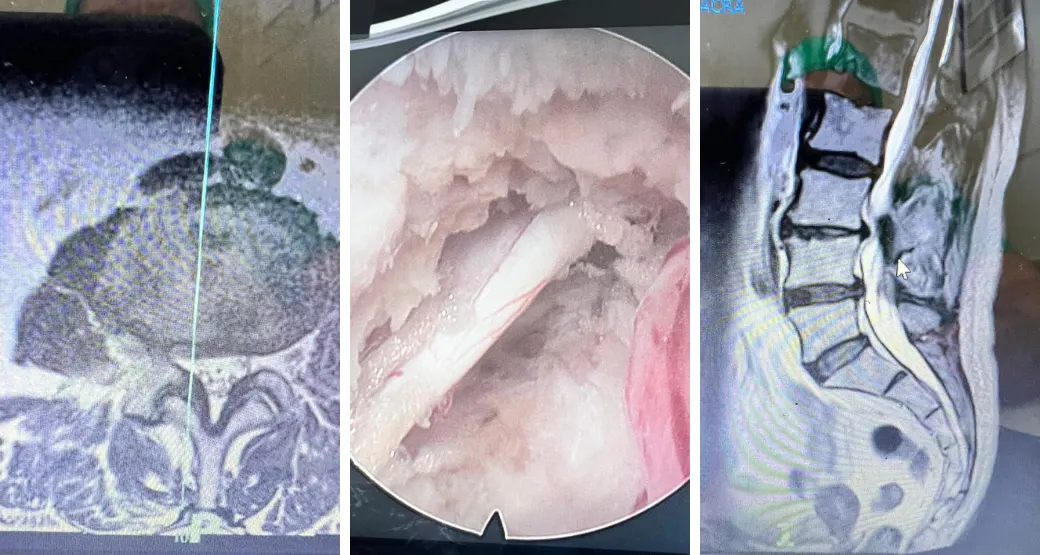 A hérnia de disco foraminal causa impacto na coluna vertebral?