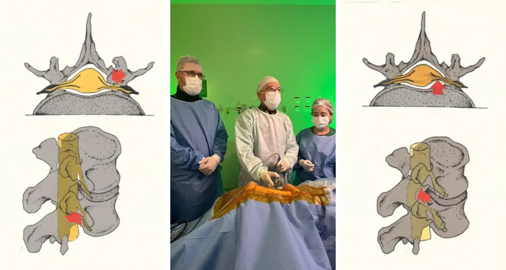 A hérnia de disco foraminal e extraforaminal causa impacto na coluna vertebral? Tem tratamento?