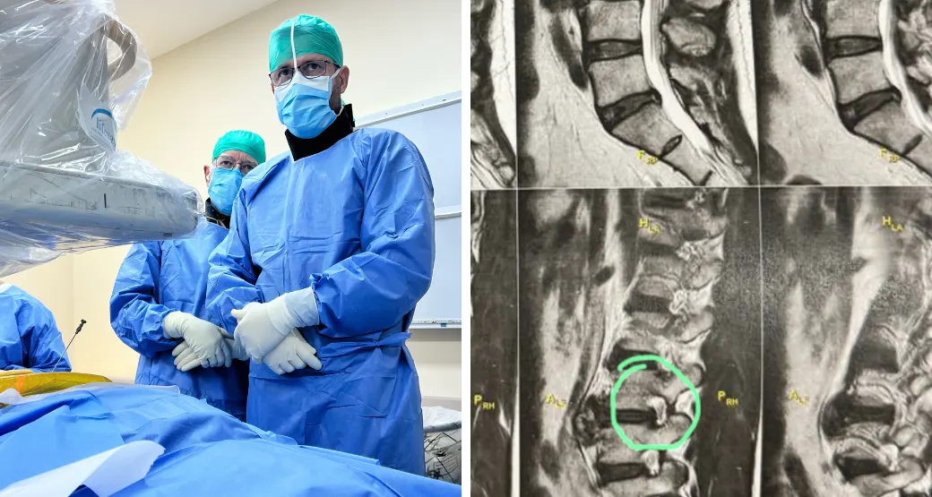 A hérnia de disco pode voltar após a cirurgia?