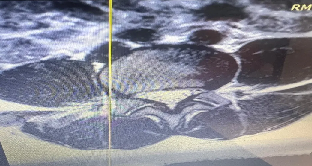 A importância do diagnóstico precoce do hematoma extradural
