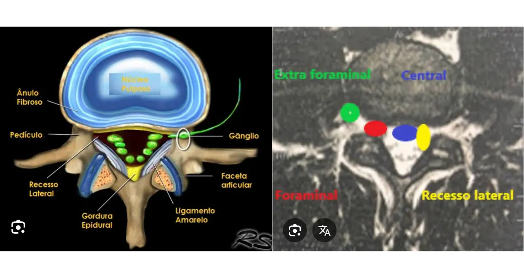 A parestesia pós-operatória pode ocorrer após uma cirurgia de coluna?