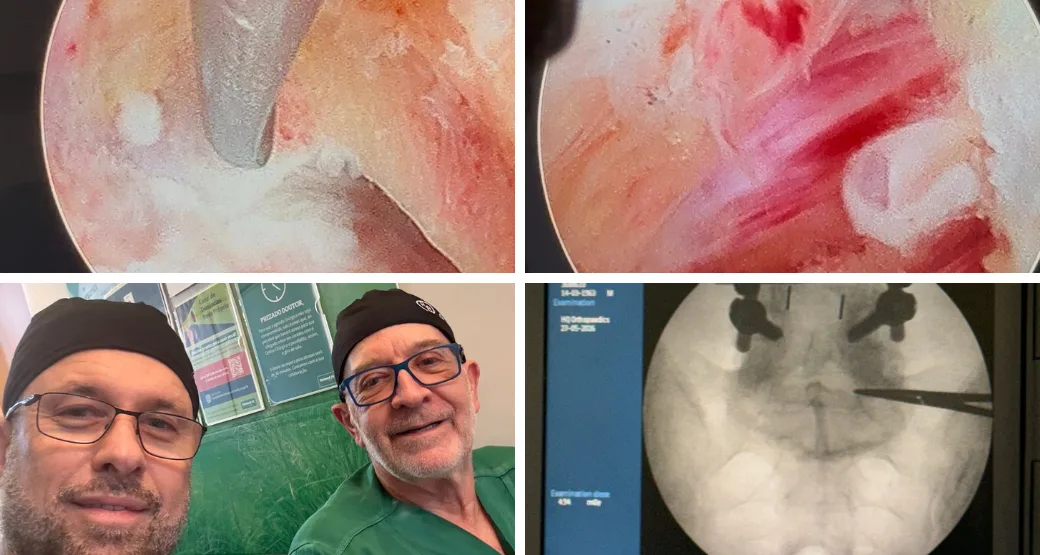 Artrodese prévia não é barreira para Endoscopia. É desafio.