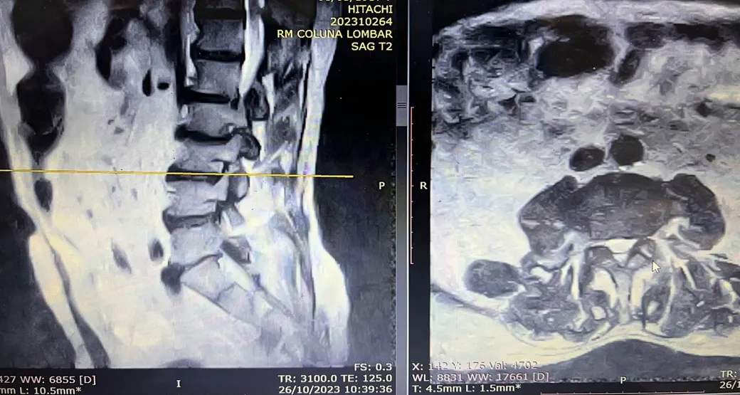 Artropatia Degenerativa: Você já ouviu falar dessa doença? Endoscopia soluciona o problema?