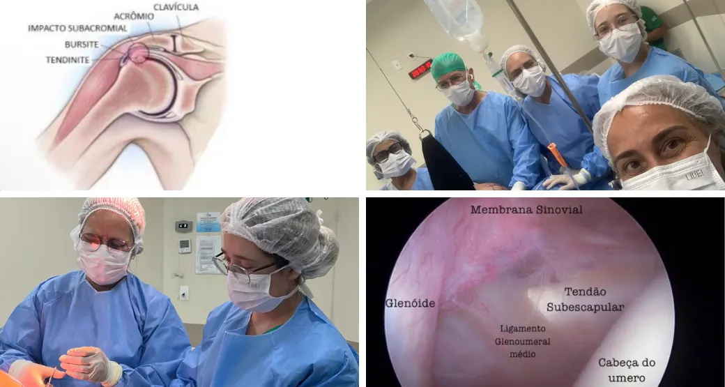 Artroscopia com Bursectomia é indicada para tratar a síndrome acromial?