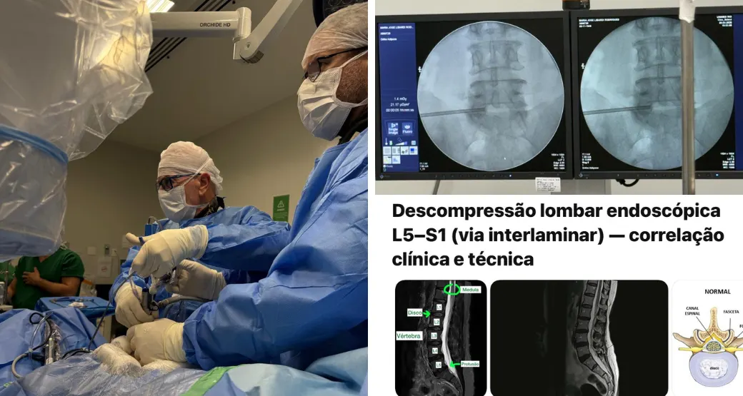 Caso complexo aos 76: cirurgia endoscópica descomprime as raízes L5 e S1