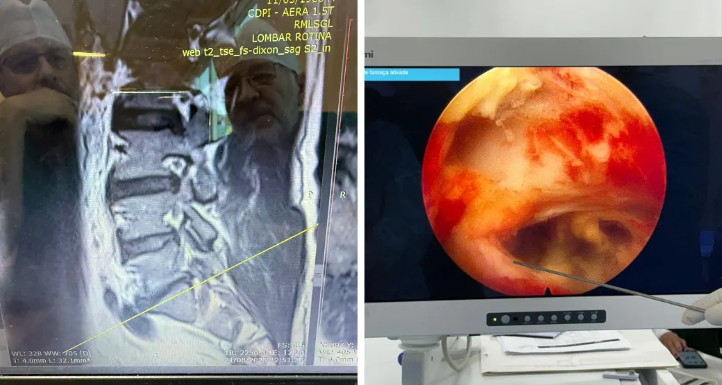 Caso desafiador de cirurgia da coluna vertebral