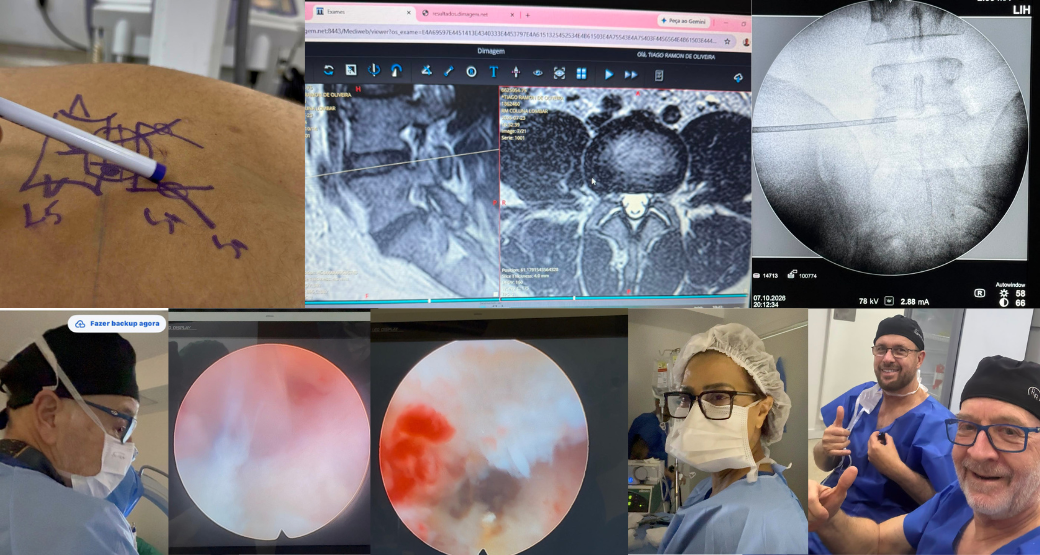 Endoscopia em coluna já operada: onde o cuidado e a técnica fazem toda a diferença