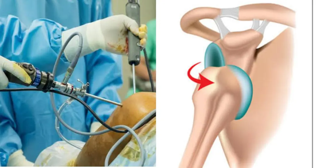 Cirurgia Artroscópica resolve a instabilidade anterior do ombro?