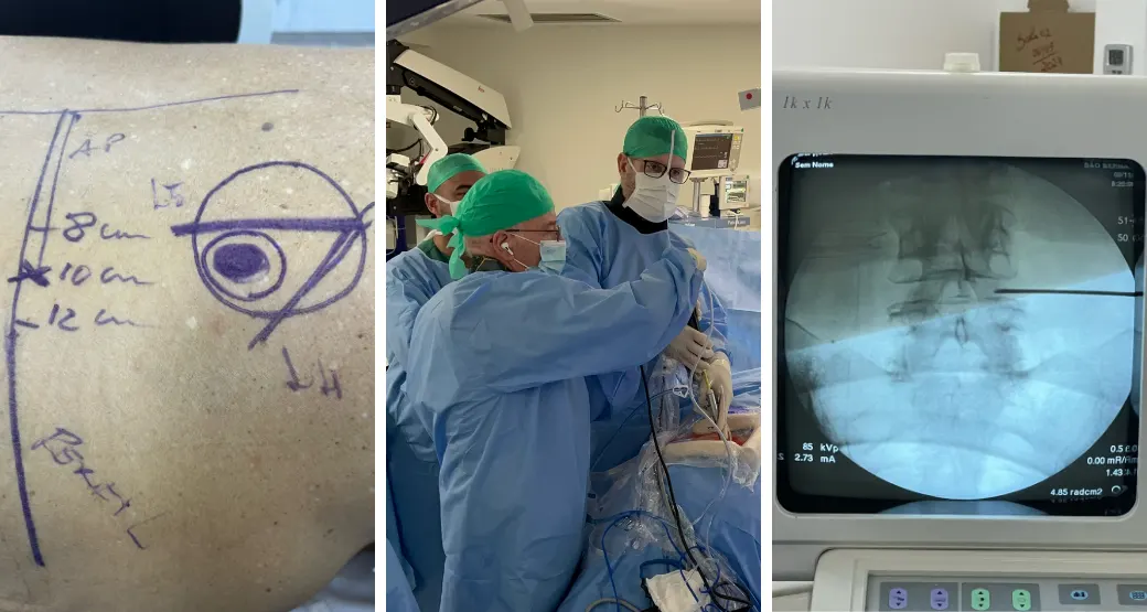Cirurgia da coluna por via endoscópica resolve hérnia discal