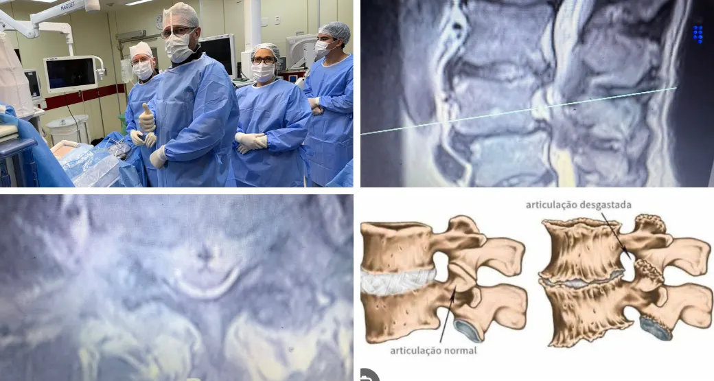 Cirurgia endoscópica ajuda a aliviar a compressão nervosa