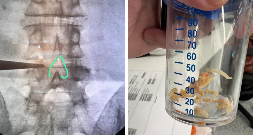 Cirurgia endoscópica alivia a dor lombar do paciente?
