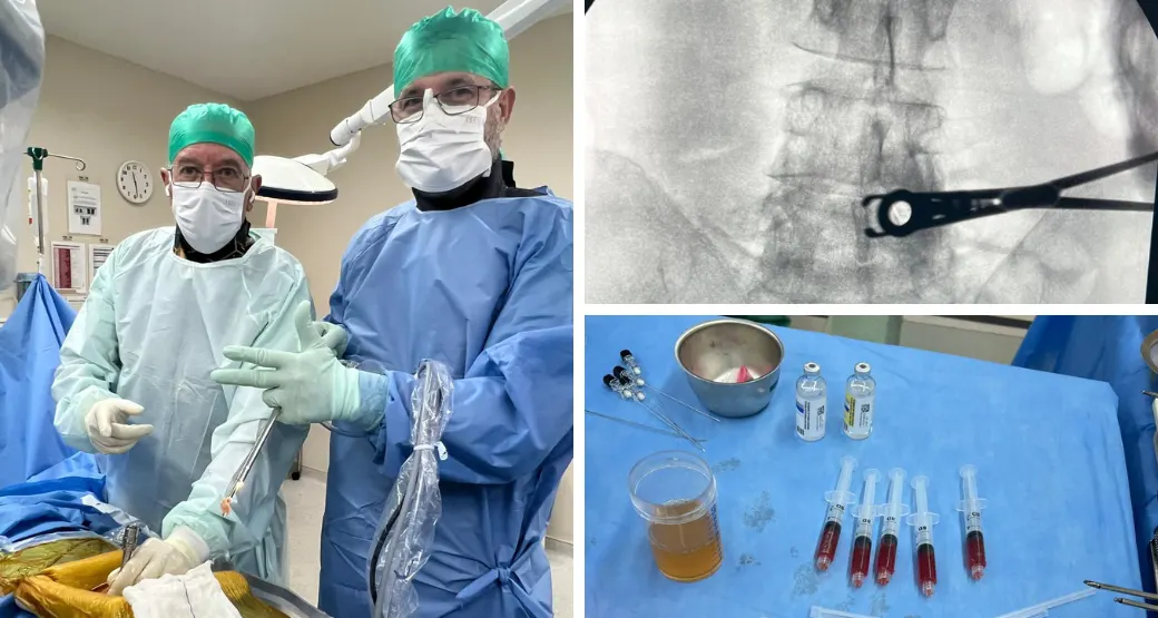 Cirurgia endoscópica auxiliada com injeções de Plasma Rico em Plaquetas um tratamento revolucionário