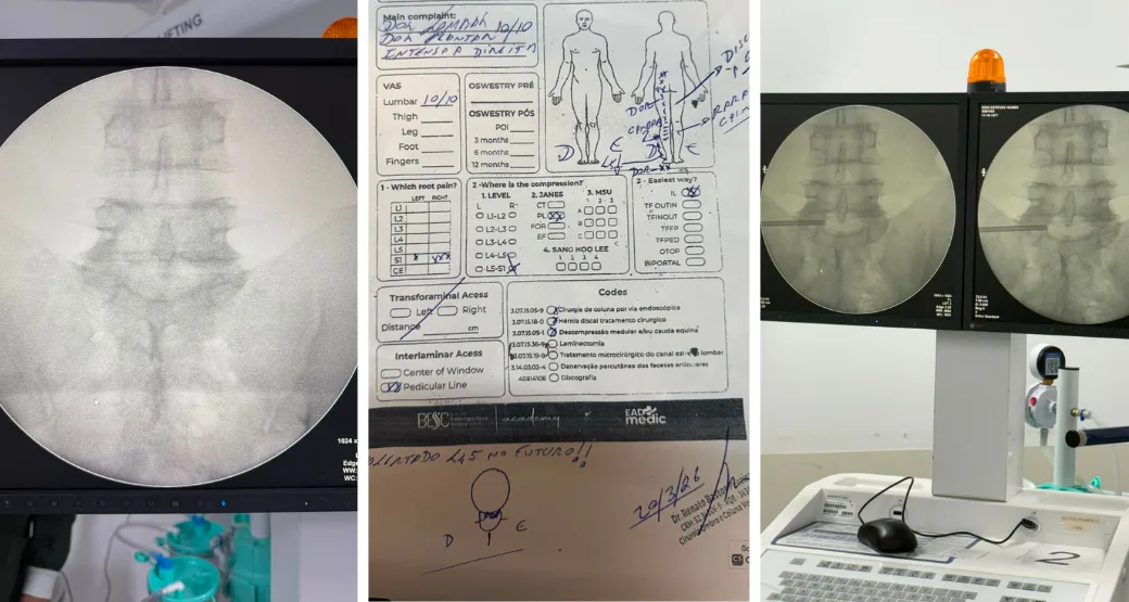Cirurgia Endoscópica da Coluna: paciente volta a ter qualidade de vida após descompressão das raízes L5 e S1