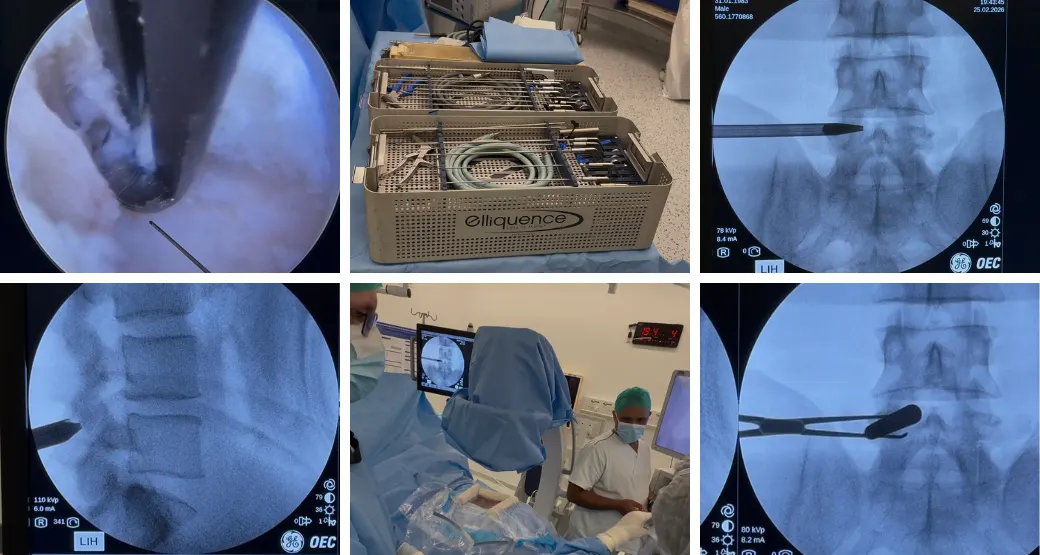 Cirurgia endoscópica é a solução para descomprimir as raízes nervosas da coluna lombar?