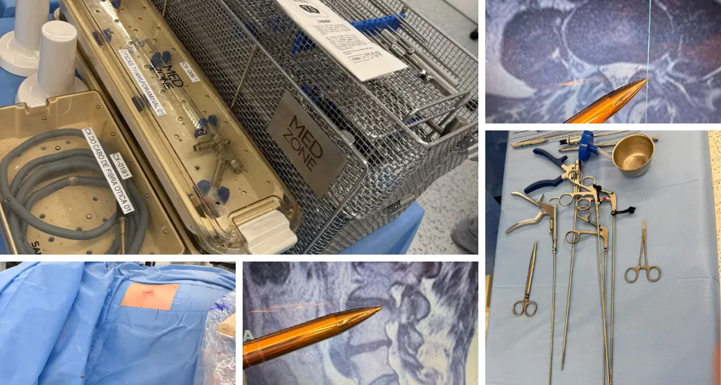 Cirurgia endoscópica transforaminal: Menos dor e recuperação rápida