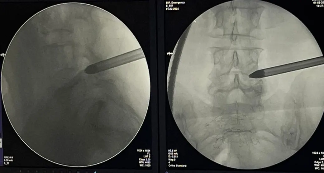 Cirurgia via endoscópica trata artropatia degenerativa mais conhecida como artrose?