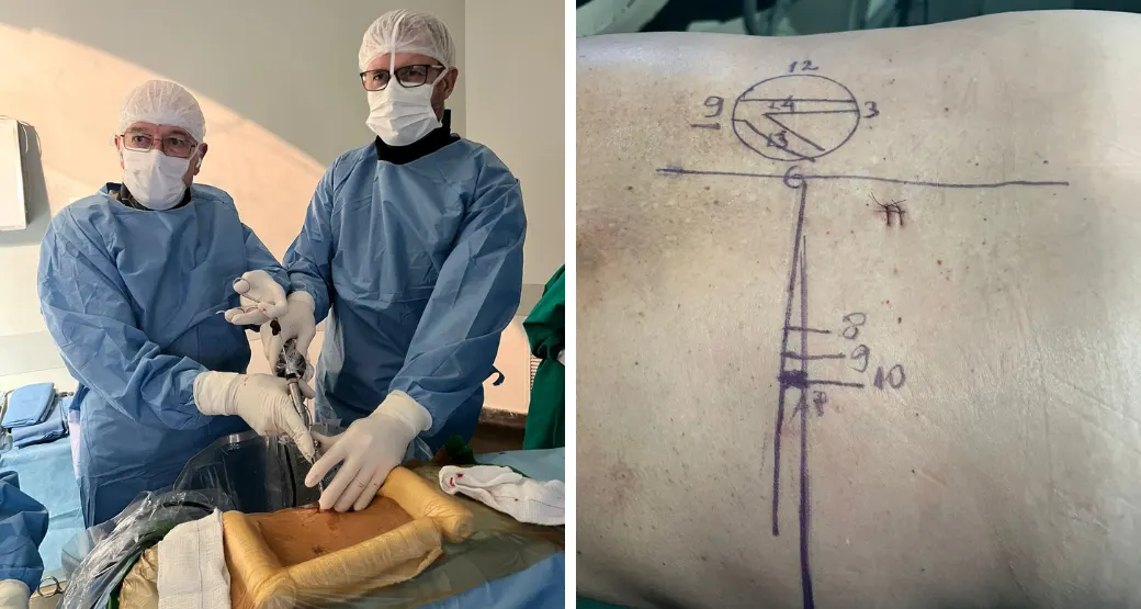 Cirurgias endoscópicas podem ser realizadas em paciente com múltiplos pontos de compressão?
