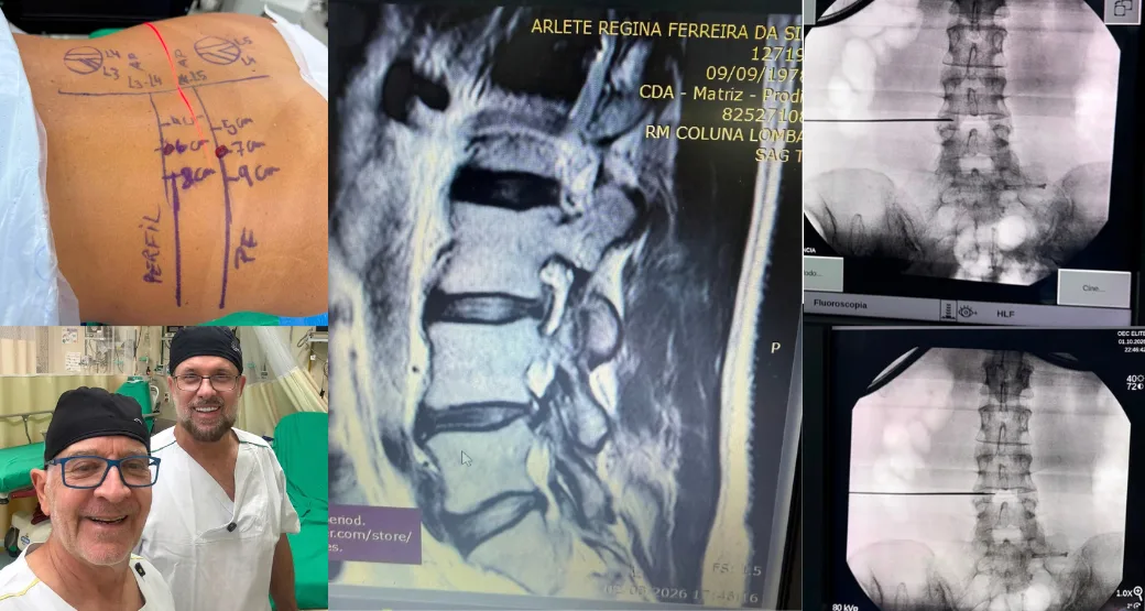 Desafio triplo: 3 hérnias extraforaminais, 3 raízes comprimidas e 1 cirurgia endoscópica