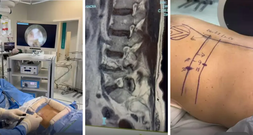 Dor ciática crônica: A cirurgia de descompressão nervosa é uma opção?