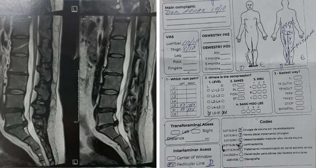 Dor lombar que irradia para as pernas? Pode ser Radiculopatia Lombossacra